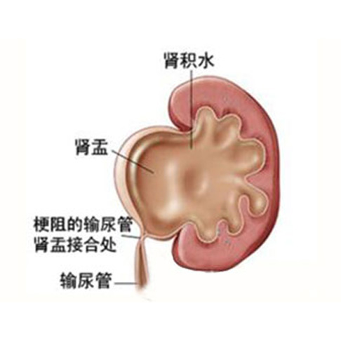 肾积水